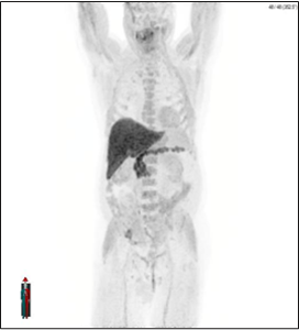 Positive Axumin scan showing asymmetric fluciclovine F 18 uptake localized to sclerotic lesion in the middle right iliac bone