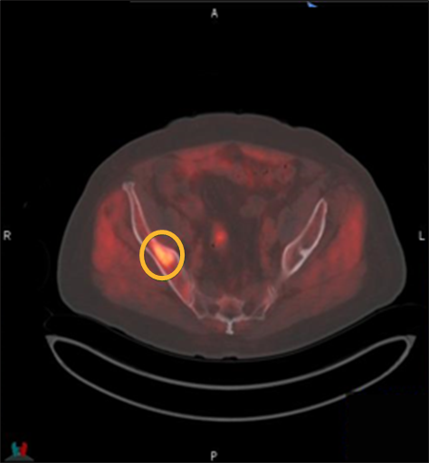 Detailed Axumin scan showing asymmetric fluciclovine F 18 uptake localized to sclerotic lesion in the middle right iliac bone