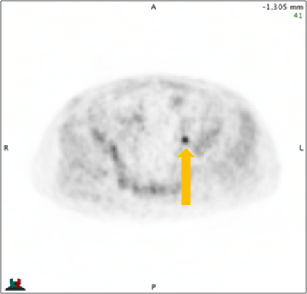 Positive Axumin black-and-white scan showing 8-mm lymph node along superior left pelvic side wall, adjacent to surgical clip